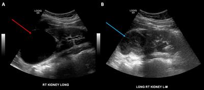 Percutaneous endoscopic creation of a neoinfundibulum for a calyceal diverticulum: A case report and review of the literature